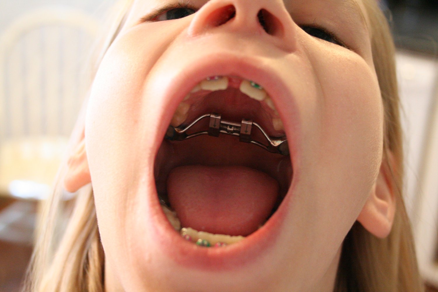 Teen braces swallow